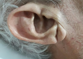 Señal en la oreja podría indicar que va a tener un infarto - Foto: El Rincón de la Medicina Interna