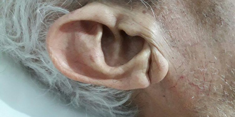 Señal en la oreja podría indicar que va a tener un infarto - Foto: El Rincón de la Medicina Interna